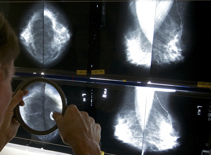 FILE - In this May 6, 2010 file photo, a radiologist uses a magnifying glass to check mammograms for breast cancer in Los Angeles. (AP Photo/Damian Dovarganes, File)