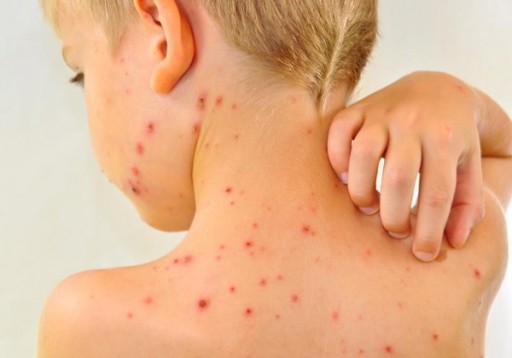 Brooklyn, NY – Williamsburg Chicken Pox Outbreak Has DOH Issuing Alert To NYC Medical Community