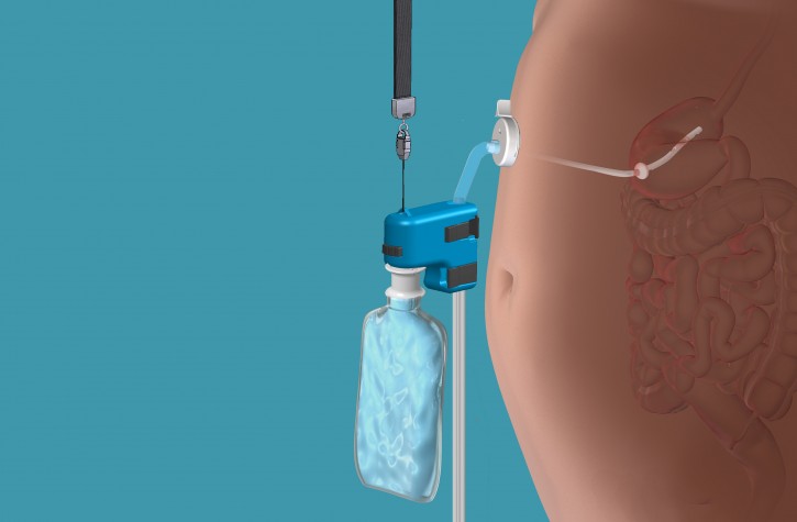 This rendering provided by Aspire Bariatrics, Inc. demonstrates the use of the AspireAssist weight loss device, approved by the Food and Drug Administration on Tuesday, June 14, 2016. The AspireAssist system consists of a thin tube implanted in the stomach which helps remove nearly a third of the food stored in the stomach before calories are absorbed into the body, causing weight loss. (Aspire Bariatrics, Inc. via AP) 