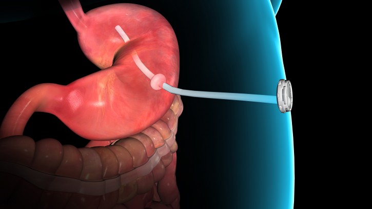 This rendering provided by Aspire Bariatrics, Inc. demonstrates the use of the AspireAssist weight loss device, approved by the Food and Drug Administration on Tuesday, June 14, 2016. The AspireAssist system consists of a thin tube implanted in the stomach which helps remove nearly a third of the food stored in the stomach before calories are absorbed into the body, causing weight loss. (Aspire Bariatrics, Inc. via AP)